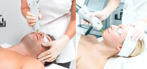 Epilation visage