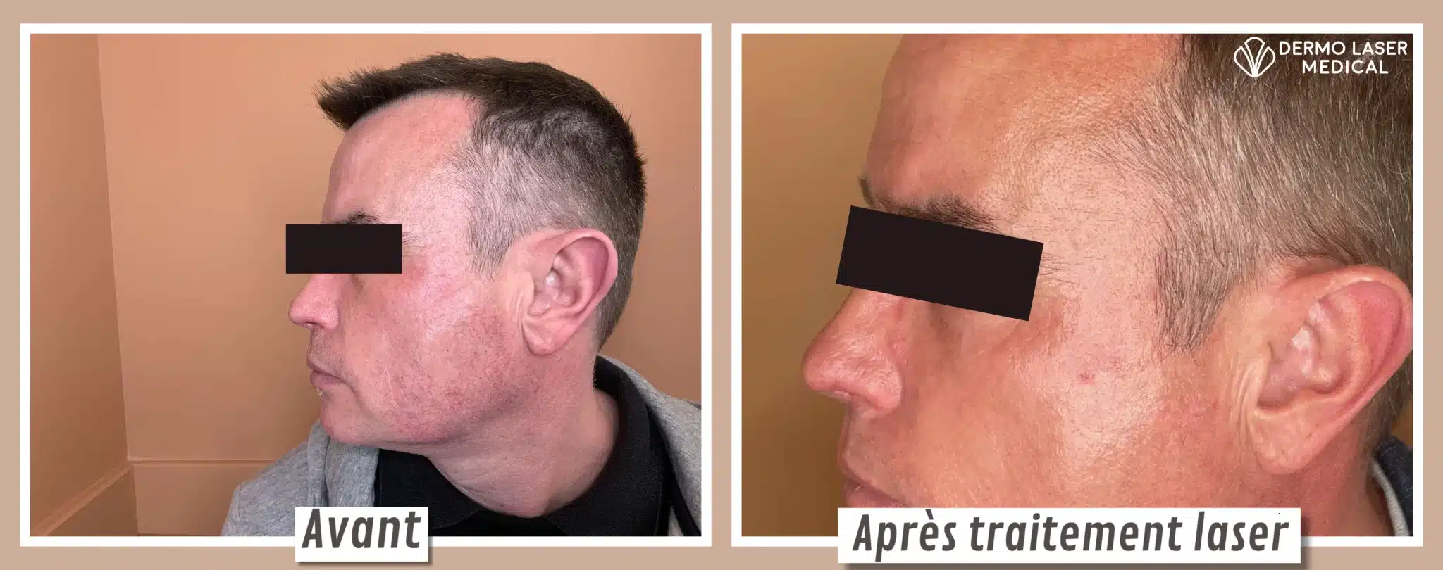 Lésions vasculaires du visage traitées au laser — Dermo Laser Lyon