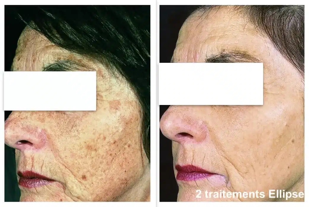 Avant / après traitement des taches pigmentaires du visage — 2 traitements Ellipse (IPL Nordlys)